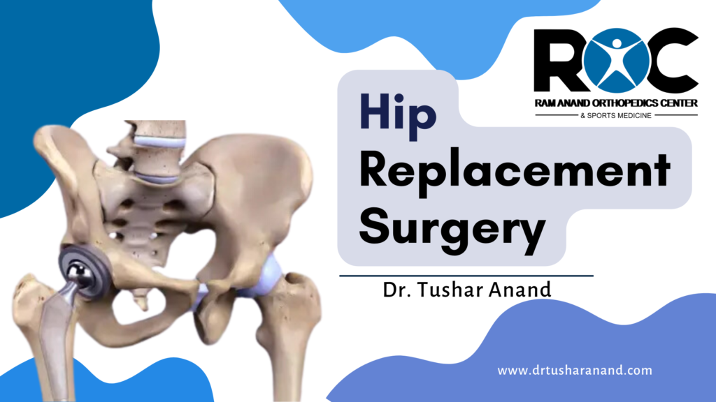 Hip Replacement Surgery: A Comprehensive Guide