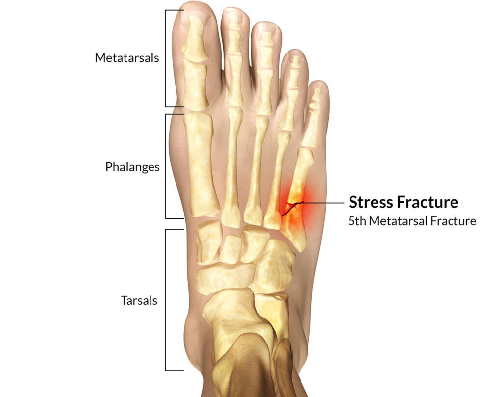 Common Foot and Ankle Injuries in Athletes