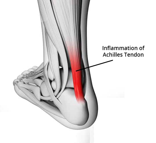 Common Foot and Ankle Injuries in Athletes