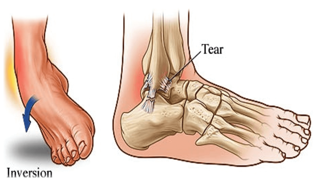 Common Foot and Ankle Injuries in Athletes