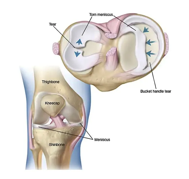 Meniscus Tear