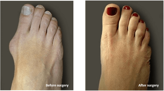 Bunion Surgery