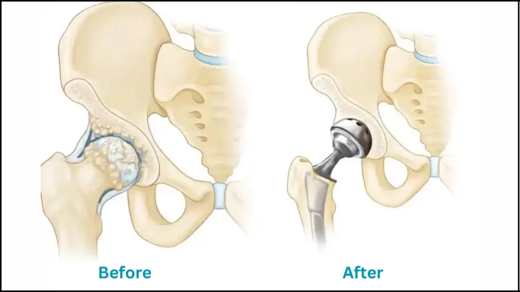 Hip Reconstruction Surgery