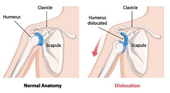 Bone Dislocation