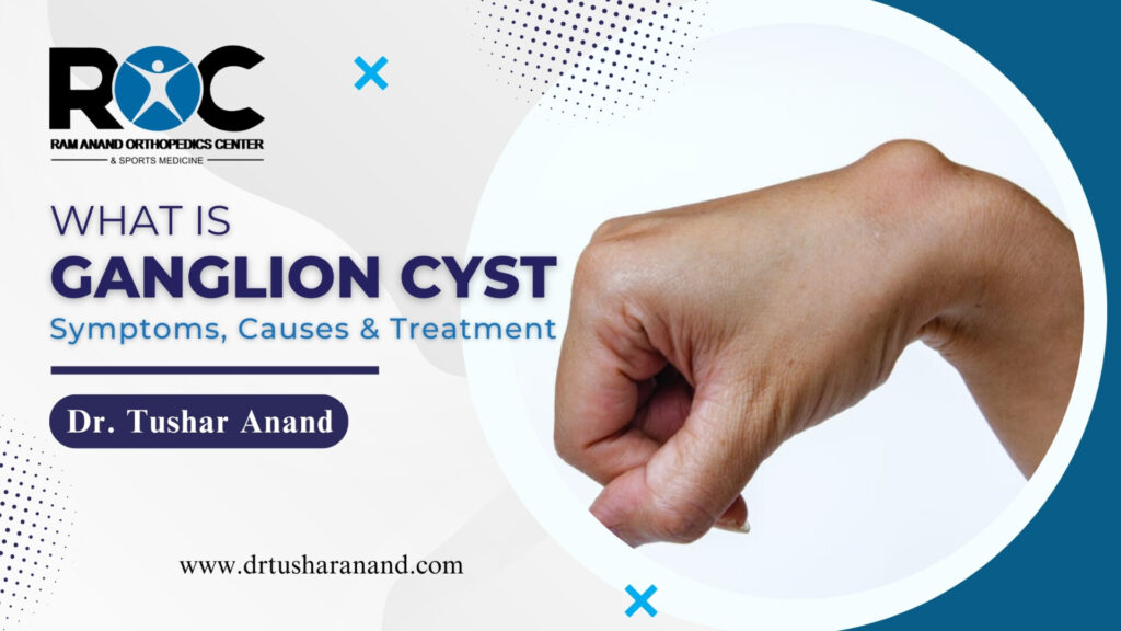 Ganglion Cyst: Identifying Causes, Recognizing Symptoms, And Finding Treatment