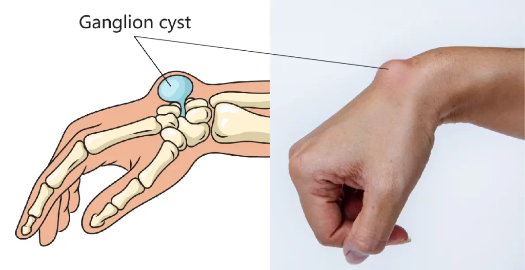 Ganglion Cyst