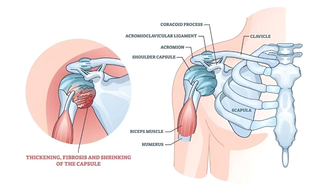 Frozen shoulder