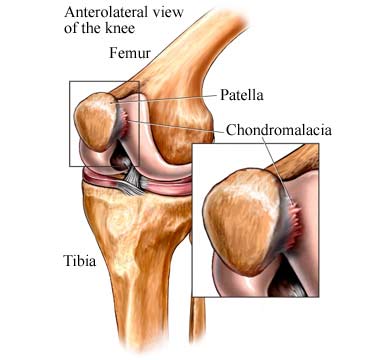 Chondromalacia